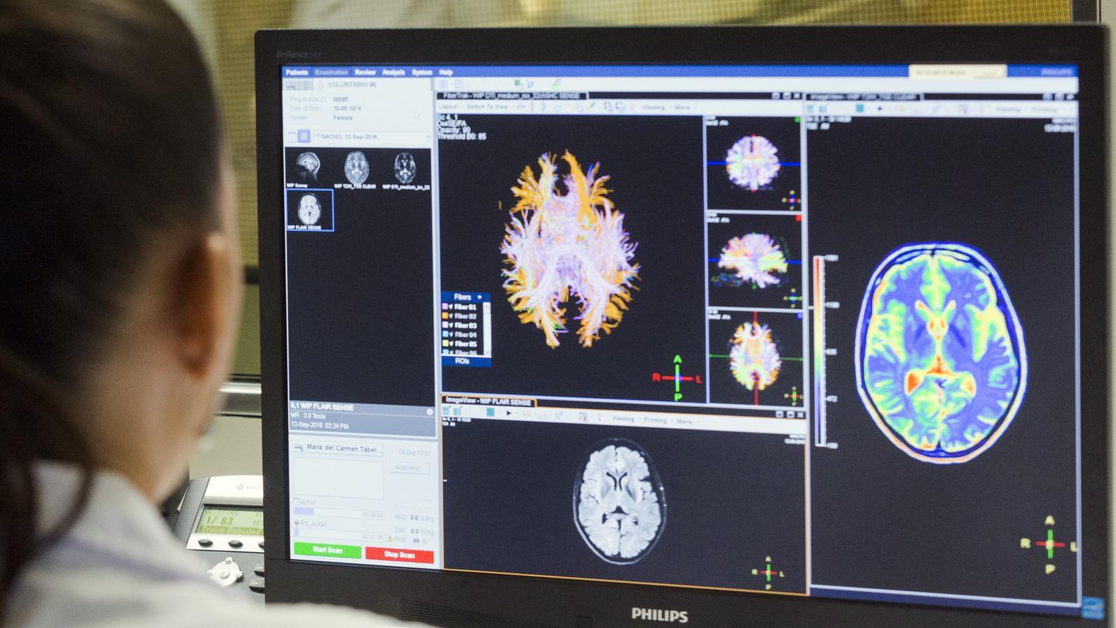 Kadınlarda Alzheimer Riskini Artıran Gizemli Protein: Yeni Araştırma Çığır Açıyor