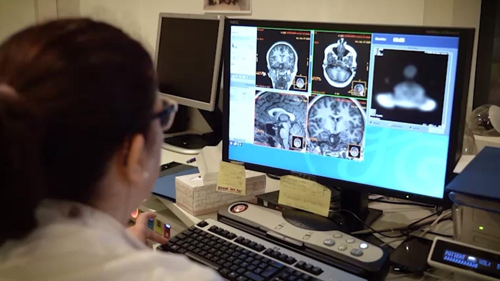 Alzheimer'ın Yayılım Sırrı Çözülüyor: Hücresel 'Otostop' Mekanizması Keşfedildi