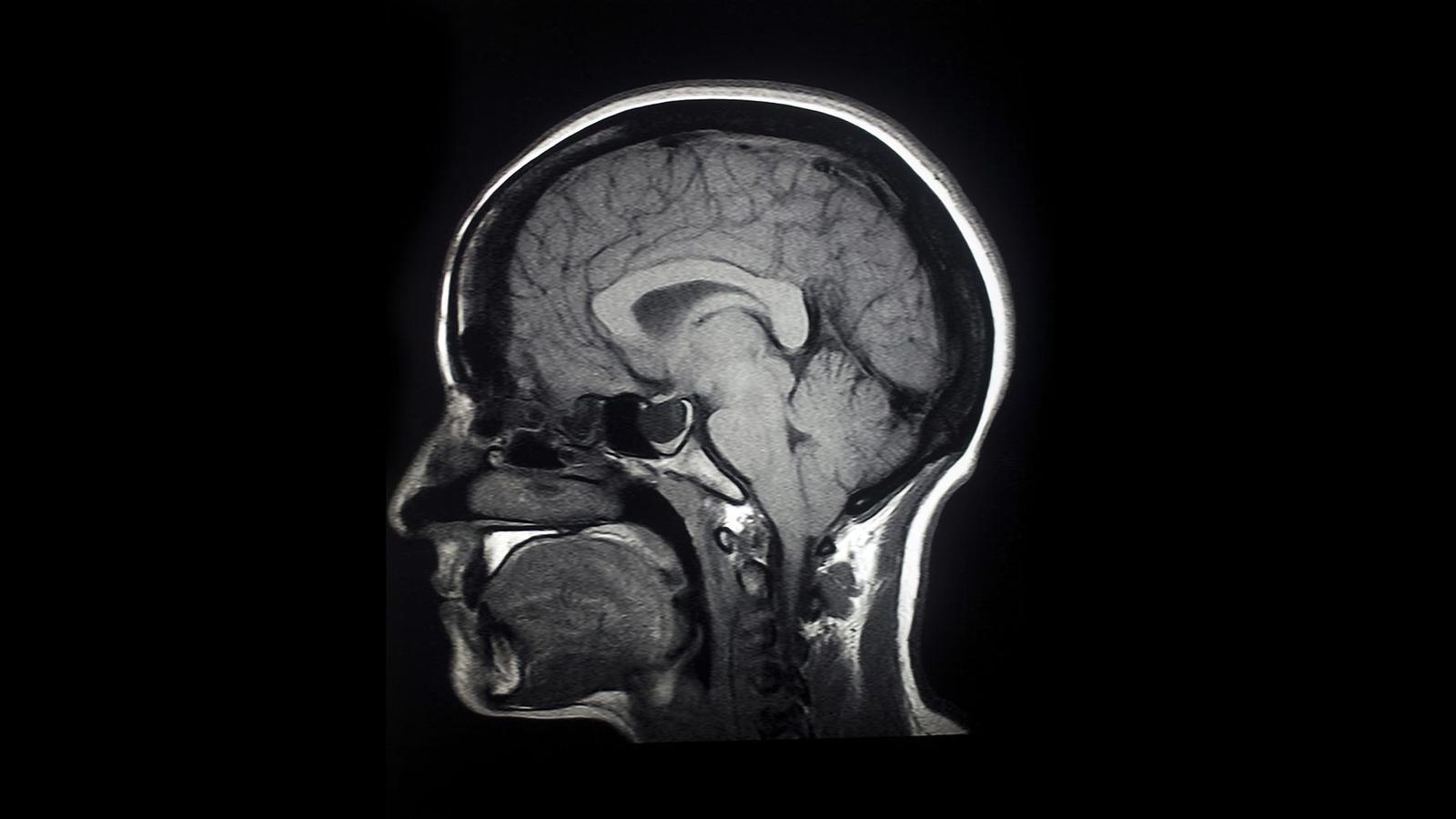 Barselona'dan Umut Işıkları: Alzheimer Tedavisinde Avrupa'da Bir İlk
